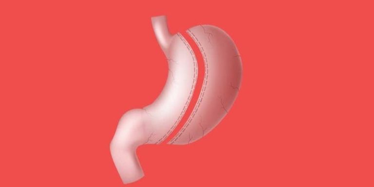 How to Avoid Gastric Sleeve Failure After Your Weight Loss Surgery
