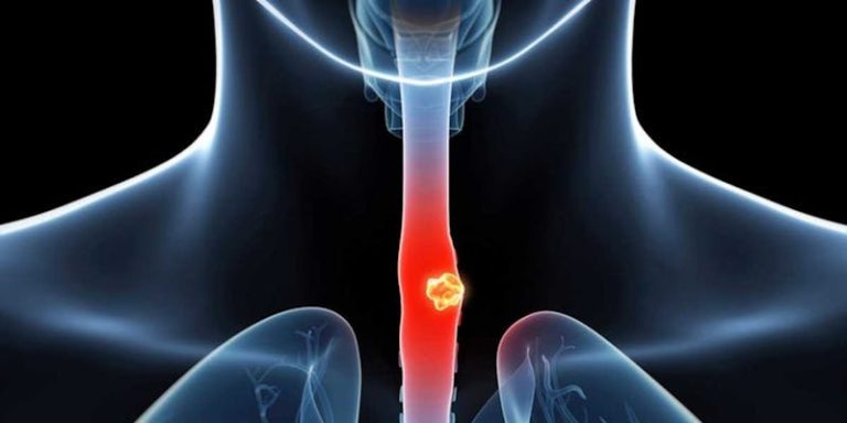 Esophageal Cancer Awareness