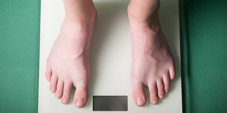 Weight Regain After Bariatric Surgery