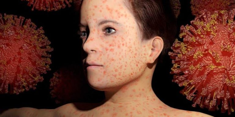 Measles outbreak