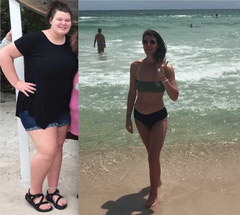 5 Ways Weight loss Surgery is Even More Important for Teens