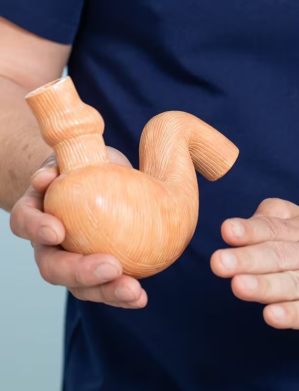 Gastric sleeve model - calorie absorption