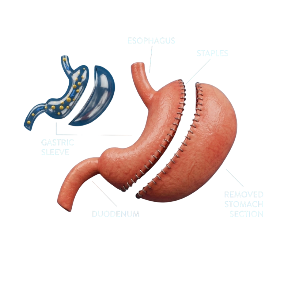 What is a Gastric Sleeve