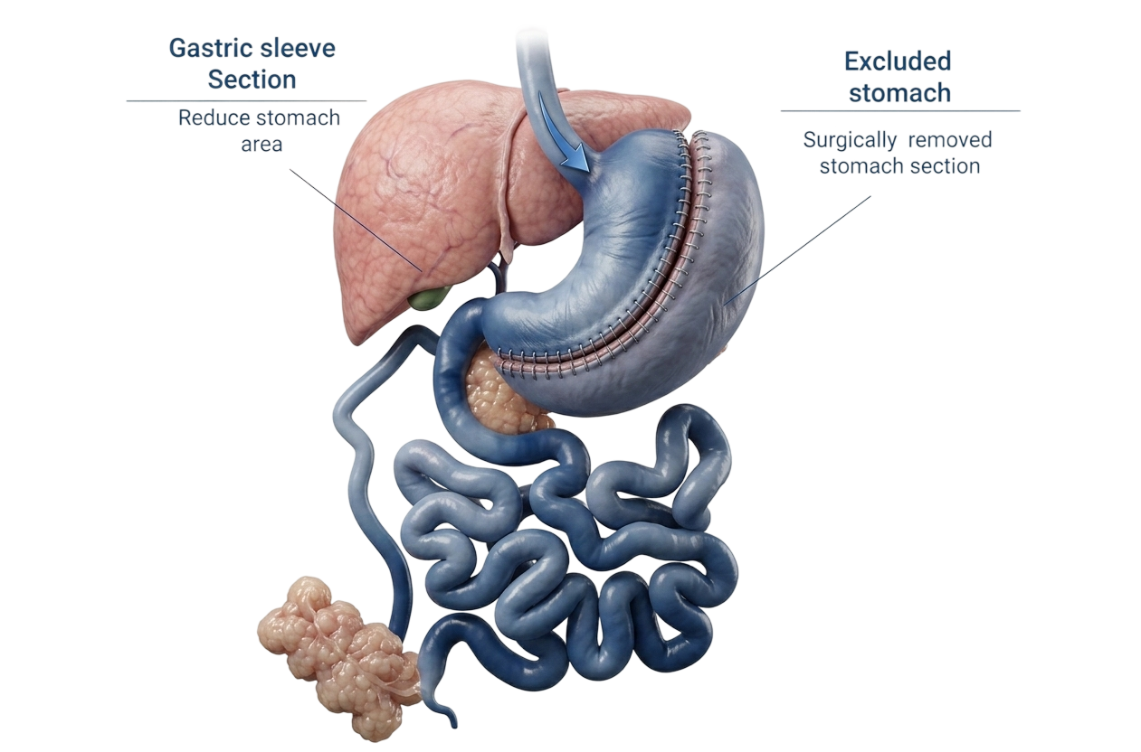 Gastric sleeve anatomy illustration