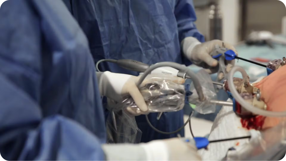 The Improved Gastric Sleeve procedure video