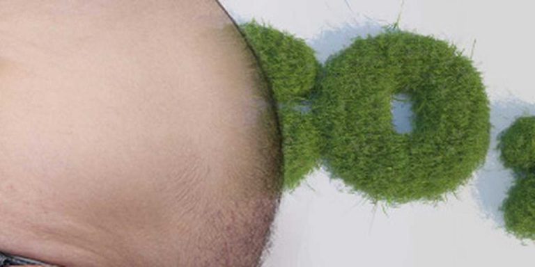 Eliminate Intra-abdominal CO2 after Gastric Sleeve Surgery