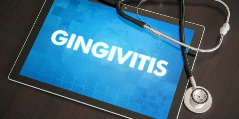 How to Prevent, Detect and Treat Gingivitis
