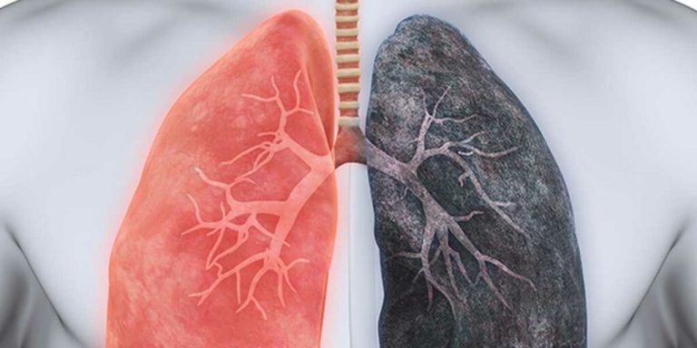 Smoking Before Bariatric Surgery… Can I?