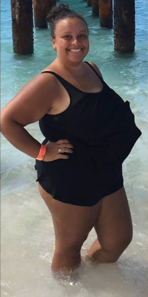 revision weight loss surgery before photo in mexico
