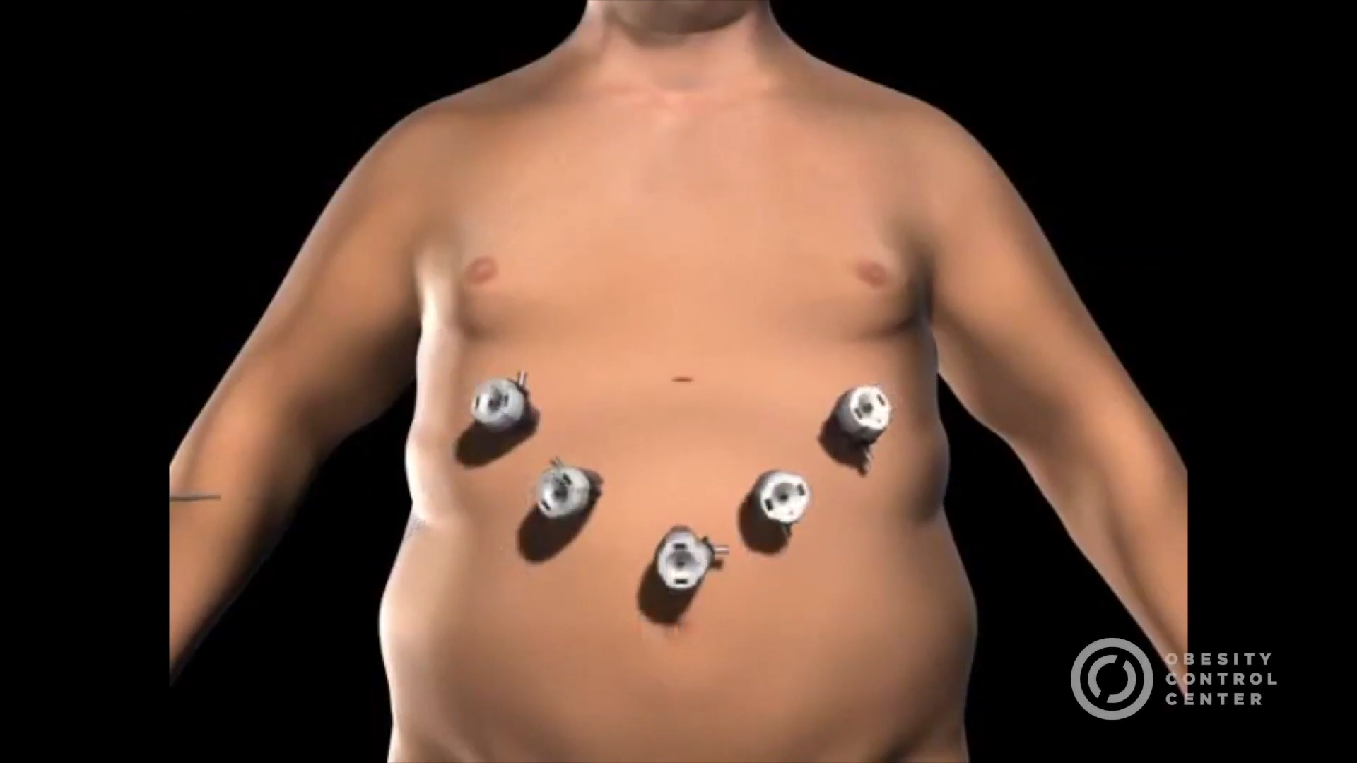 Gastric Sleeve Patient Testimonials