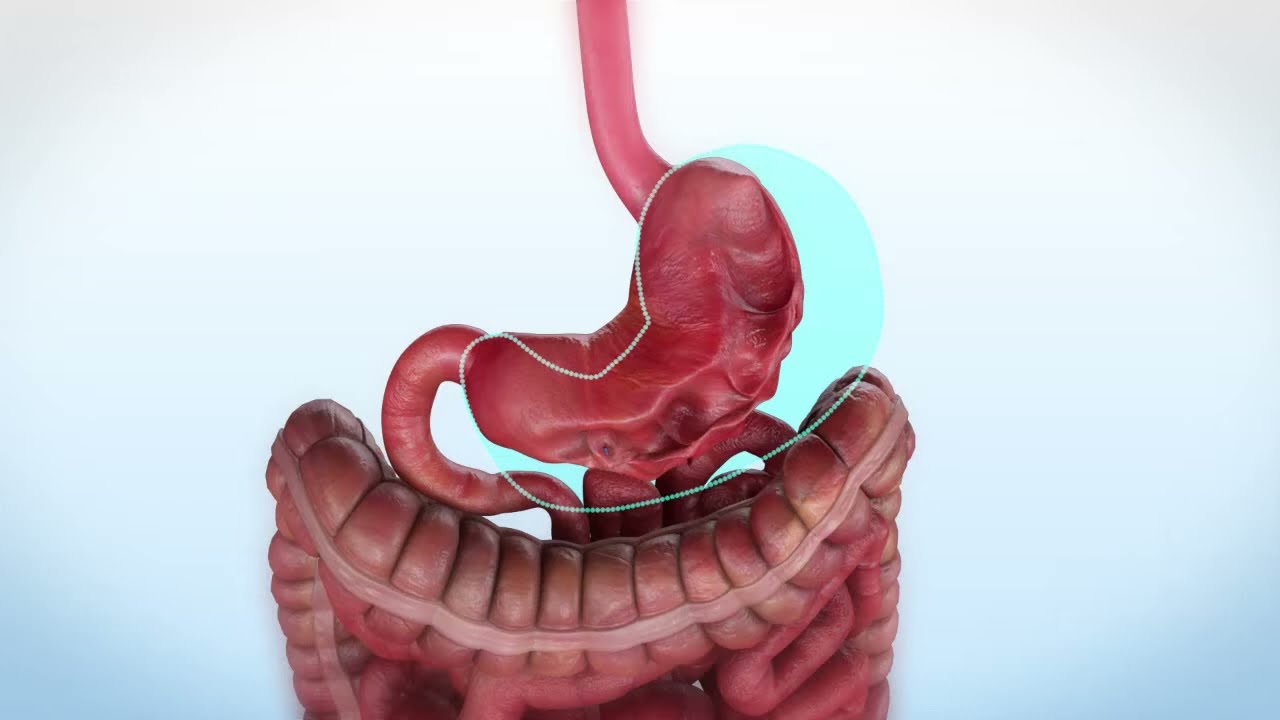 Gastric Sleeve Patient Testimonials